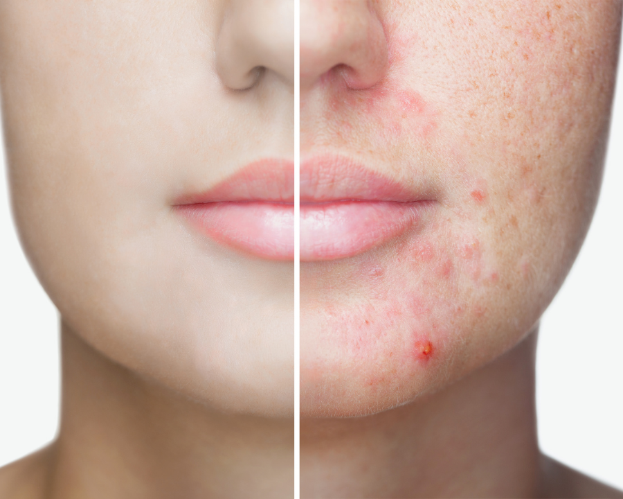 Before and after acne treatment